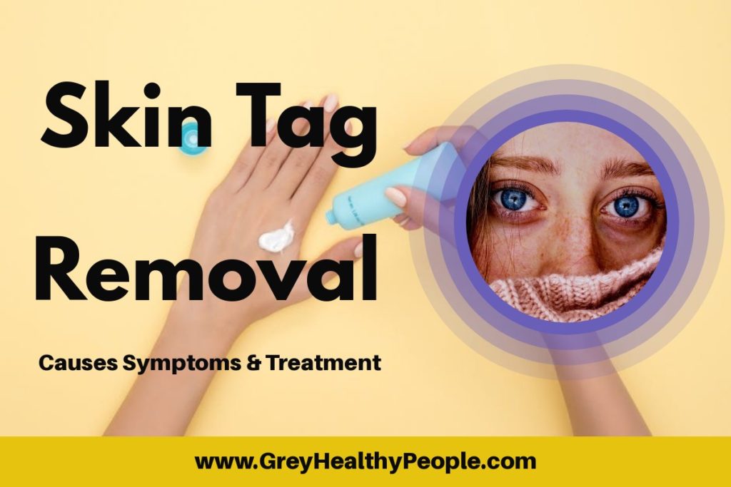Skin tag removal causes symptoms and treatment